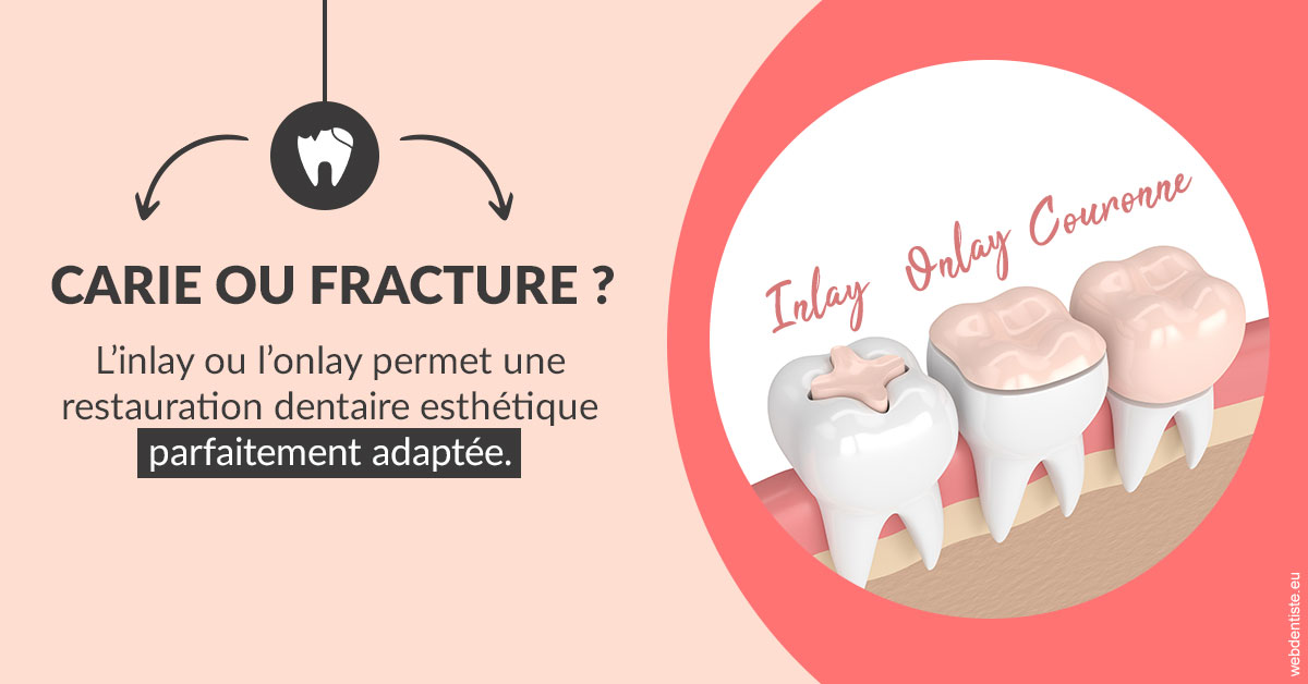 https://dr-nicolas-baert.chirurgiens-dentistes.fr/T2 2023 - Carie ou fracture 2