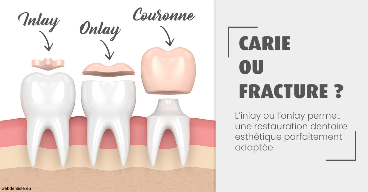 https://dr-nicolas-baert.chirurgiens-dentistes.fr/T2 2023 - Carie ou fracture 1