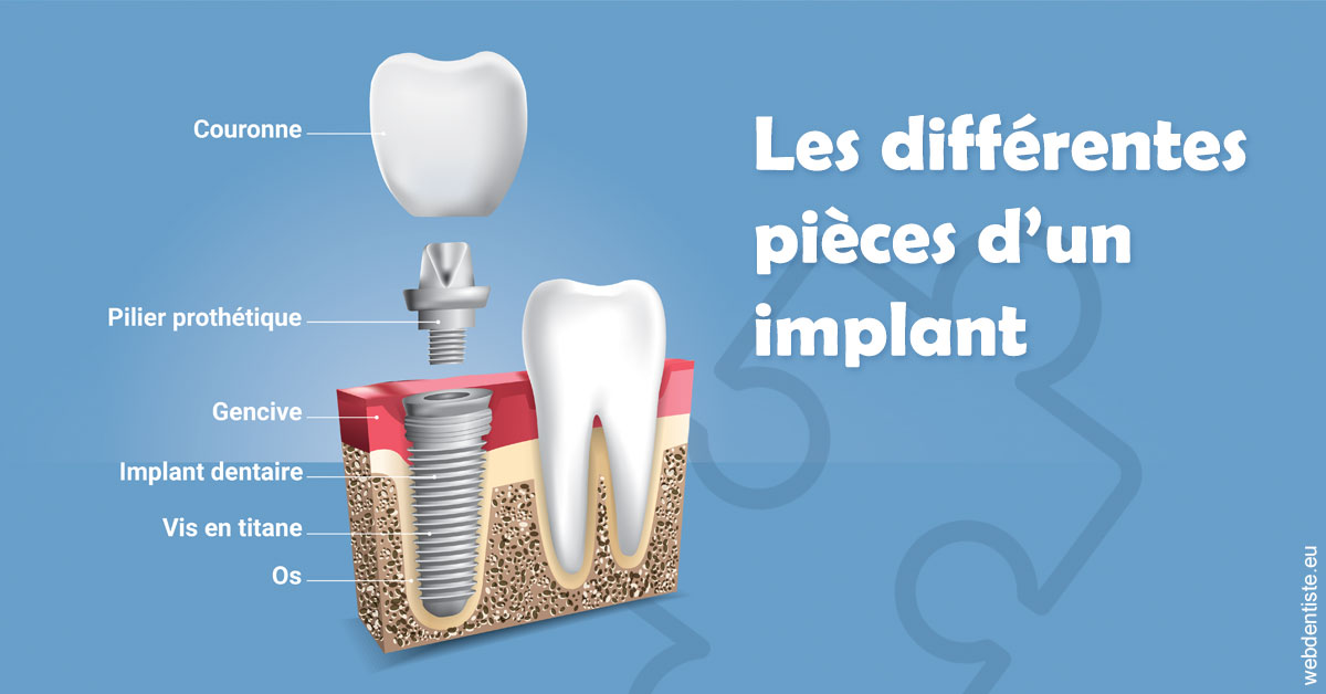 https://dr-nicolas-baert.chirurgiens-dentistes.fr/Les différentes pièces d’un implant 1